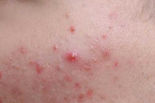 5 cách chăm sóc da và hạn chế trứng cá đỏ tái phát