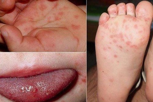 Trẻ đã từng mắc tay chân miệng vẫn có thể mắc lại