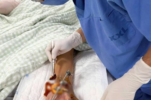 Bé trai 8 tuổi đứt lìa bàn tay, bác sĩ nối tạm vào cổ chân để bảo tồn chi
