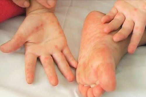 Tay chân miệng vào mùa, dù có vaccine, vẫn không thể chủ quan