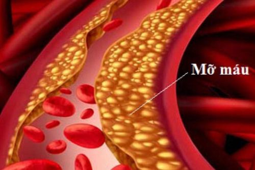 Mỡ máu cao âm thầm hại tim