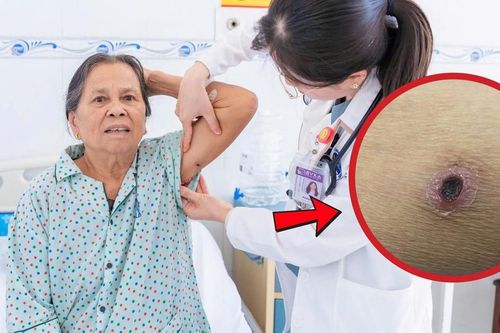Ve mò đốt, cụ bà nhiễm trùng huyết nguy kịch