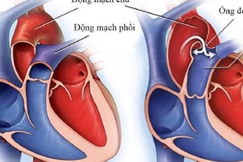 4 dấu hiệu bệnh tim bẩm sinh ở trẻ cha mẹ cần lưu ý