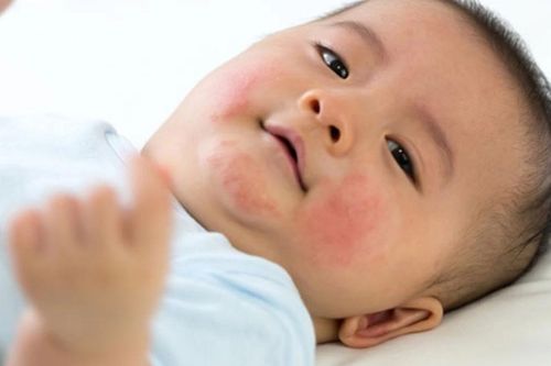 Làm sao biết con bạn bị dị ứng sữa?