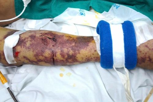 Suy đa tạng vì thói quen xấu lặp lại suốt nhiều năm
