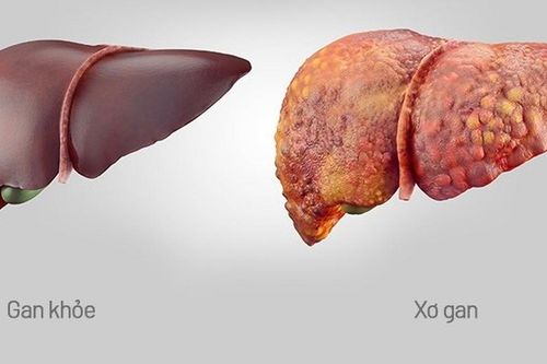 Lá gan sẽ 'mệt' thế nào nếu lạm dụng thực phẩm chức năng?