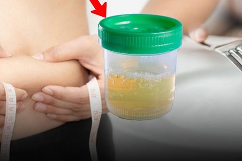 Nhịn ăn giảm cân, người phụ nữ 30 tuổi phát hiện tiểu đường, nước tiểu đầy bọt