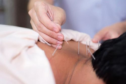 Châm cứu trong y học hiện đại: Giá trị truyền thống, ứng dụng mới