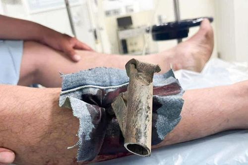 Chân chống xe máy găm cẳng chân, người đàn ông phải mang cả vào phòng cấp cứu