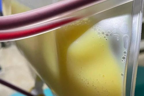 Người phụ nữ 30 tuổi 'máu trắng đục như sữa' vì thói quen nhiều người mắc mà không hay