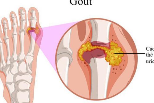 Vì sao người trẻ có thể mắc gout?