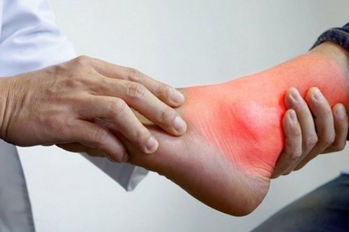 Bệnh gout không chỉ do ăn uống