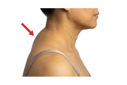2 bài tập đơn giản tại nhà giúp cải thiện tư thế gù cổ