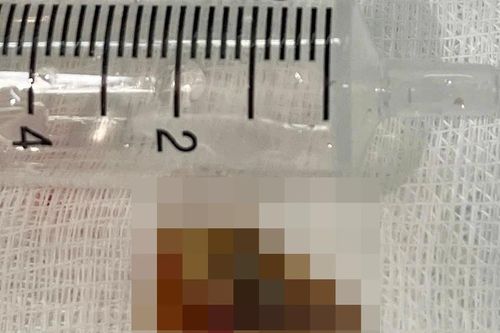 Mảnh xương 2 cm nằm sâu trong phế quản, gây tắc phổi và nhiều ổ mủ