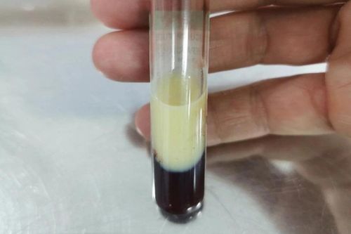 Một thói quen sau ăn khiến mỡ máu tăng vọt