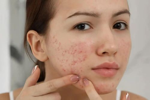 5 cách chăm sóc da sau mụn giúp vùng thâm sạm dần cải thiện