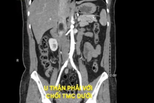 Lấy trọn khối u thận hiếm gặp qua phẫu thuật nội soi