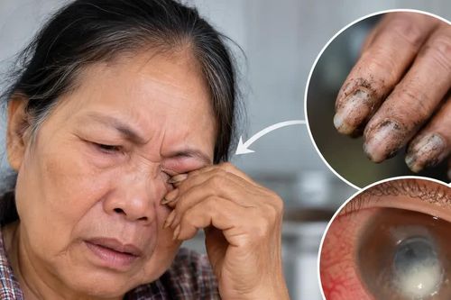 Dụi mắt bằng tay bẩn, người phụ nữ suýt mất thị lực