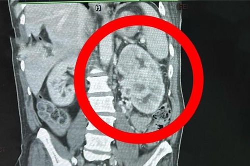 Có dấu hiệu này nhưng không đi khám, người đàn ông 64 tuổi mắc ung thư giai đoạn 4