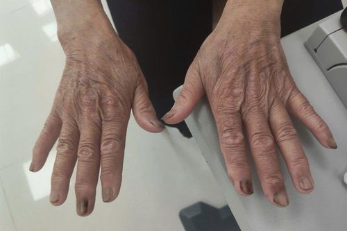 Móng tay dài, cặn bẩn đầy kẽ khiến người phụ nữ loét giác mạc