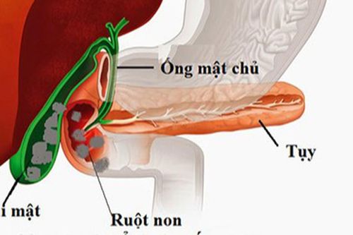 Sỏi túi mật khi nào cần mổ cấp cứu?