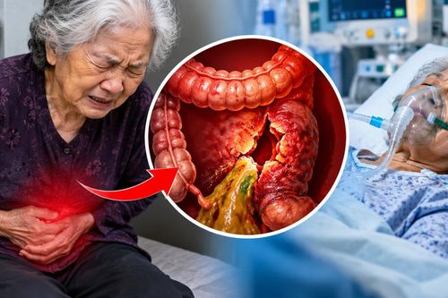 Tự thụt tháo vì táo bón, cụ bà 81 tuổi vỡ đại tràng, nguy kịch