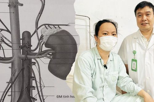 Không triệu chứng, người phụ nữ bất ngờ phát hiện u thận lan vào tĩnh mạch chủ