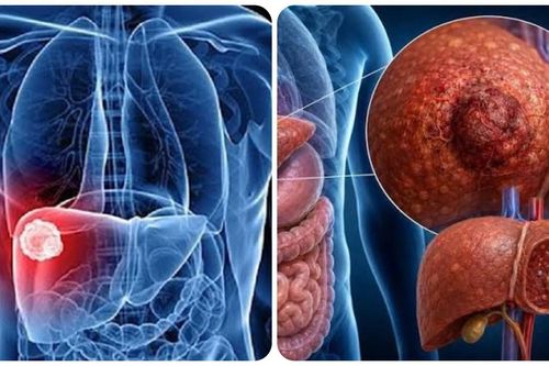 9 triệu chứng ung thư gan giai đoạn đầu