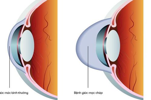 Giác mạc chóp - bệnh lý giác mạc cần được phát hiện và điều trị sớm