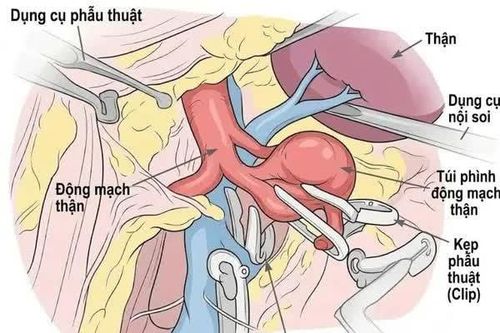 Thực hiện thành công phẫu thuật nội soi kẹp túi phình động mạch thận