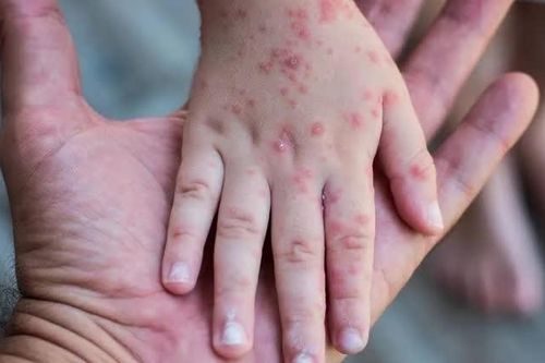 Pennsylvania ghi nhận đợt bùng phát dịch sởi lớn nhất tại Mỹ