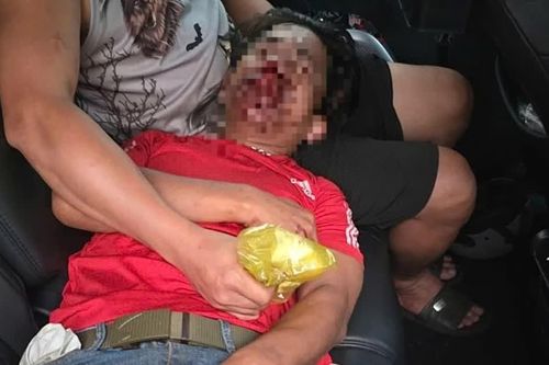 Cảnh sát dẫn đường hơn 20km giúp bệnh nhân đứt lưỡi đi cấp cứu