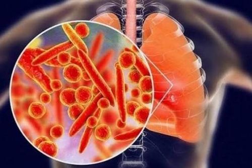 Bộ Y tế khuyến cáo người dân trước thông tin ca tử vong do viêm phổi tại Nga