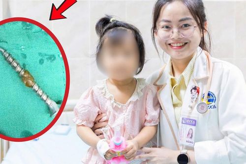 Bé gái 30 tháng tuổi suýt thủng đường tiêu hóa vì nuốt đinh vít 3cm khi chơi