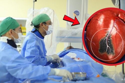 Người đàn ông 57 tuổi bất ngờ lên cơn nhồi máu cơ tim sau bữa tối