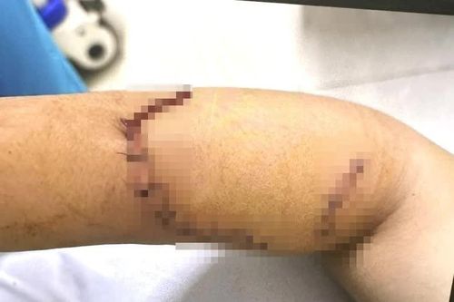 Sức khỏe nữ sinh lớp 9 bị bạn dùng dao tấn công gây đa thương tích ở Đắk Lắk