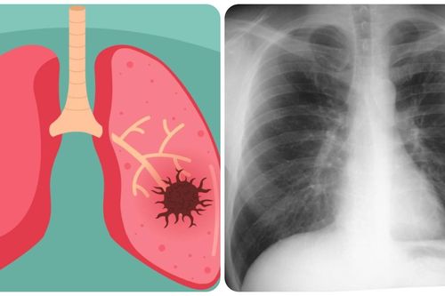 9 dấu hiệu ung thư phổi giai đoạn đầu