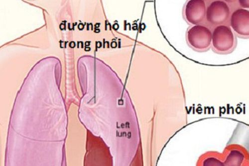 5 cách giúp chủ động phòng ngừa viêm phổi khi chuyển mùa