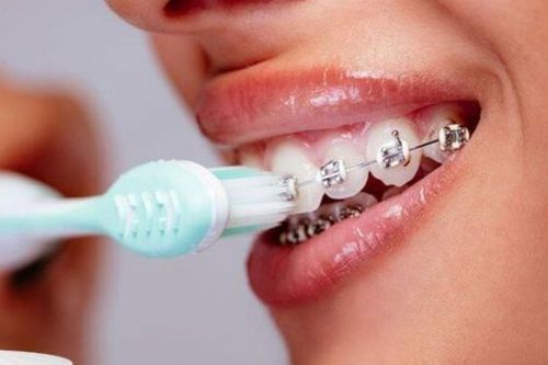 Vệ sinh răng miệng khi niềng răng như thế nào?