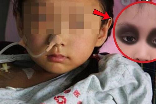 Mắt bé gái 4 tuổi chuyển màu tím vì ung thư, mẹ hối hận vì điều này
