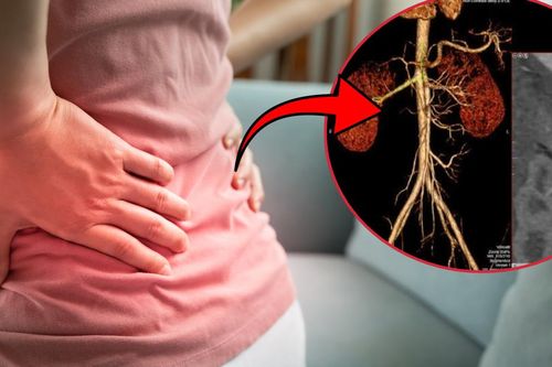 Đi khám vì đau hông lưng, phát hiện túi phình động mạch thận kích thước lớn