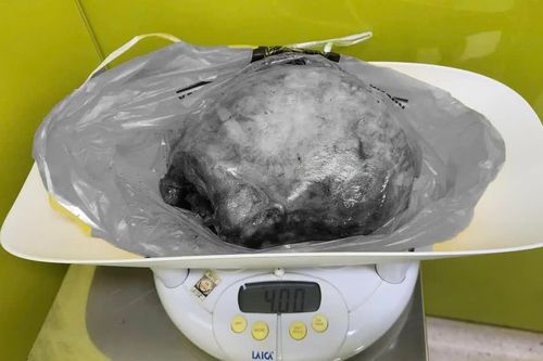Bé trai chào đời an toàn dù mẹ mang khối u xơ tử cung 4kg