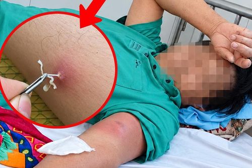 Uống nước suối khi đi rừng, người đàn ông bất ngờ mắc bệnh giun rồng nguy hiểm