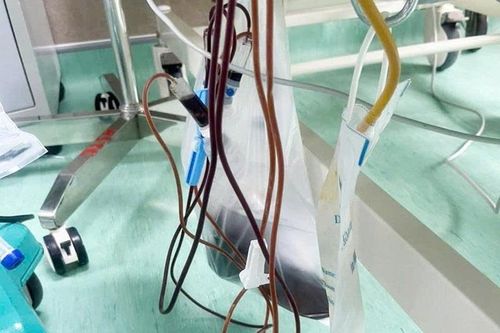 Người đàn ông đi cấp cứu với mỡ máu tăng 20 lần, máu đục như sữa