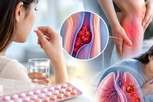 Phụ nữ thừa cân, ít vận động cần lưu ý nguy cơ huyết khối khi dùng thuốc tránh thai
