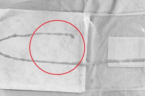 Người phụ nữ 48 tuổi sốc khi bác sĩ gắp ra thứ 'đáng sợ' bên trong bụng