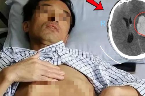 Người đàn ông đang khỏe mạnh bất ngờ đột quỵ, dấu hiệu nhiều người Việt bỏ qua