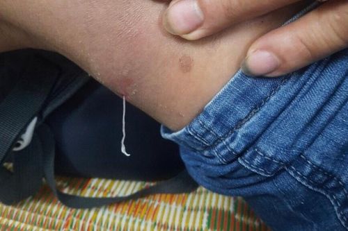 Giun rồng đục khoét, chui ra từ dưới da bệnh nhân