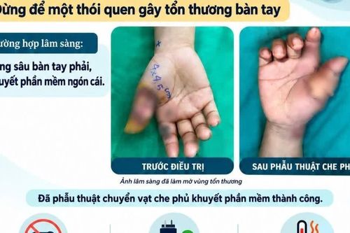 Bệnh nhân bỏng sâu bàn tay do điện thoại nổ khi sạc