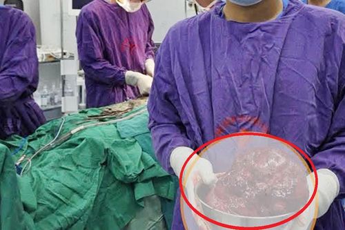Bụng to bất thường, người đàn ông sốc khi bác sĩ gắp ra thứ 'đáng sợ' nặng 2kg bên trong